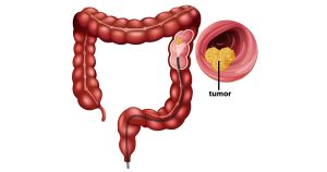 #MarçoAzul mês do combate ao câncer colorretal